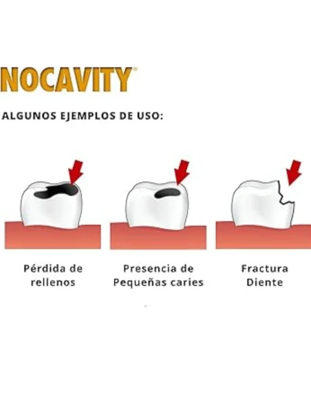 KIT PARA LA OBTURACIÓN DENTAL PROVISIONAL - NOCAVITY